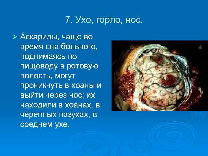 7. Ухо, горло, нос. Ø Аскариды, чаще во время сна больного, поднимаясь по пищеводу