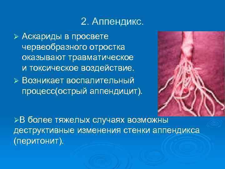 2. Аппендикс. Аскариды в просвете червеобразного отростка оказывают травматическое и токсическое воздействие. Ø Возникает