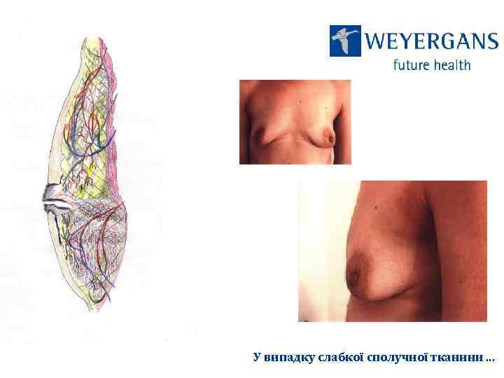 У випадку слабкої сполучної тканини. . . 