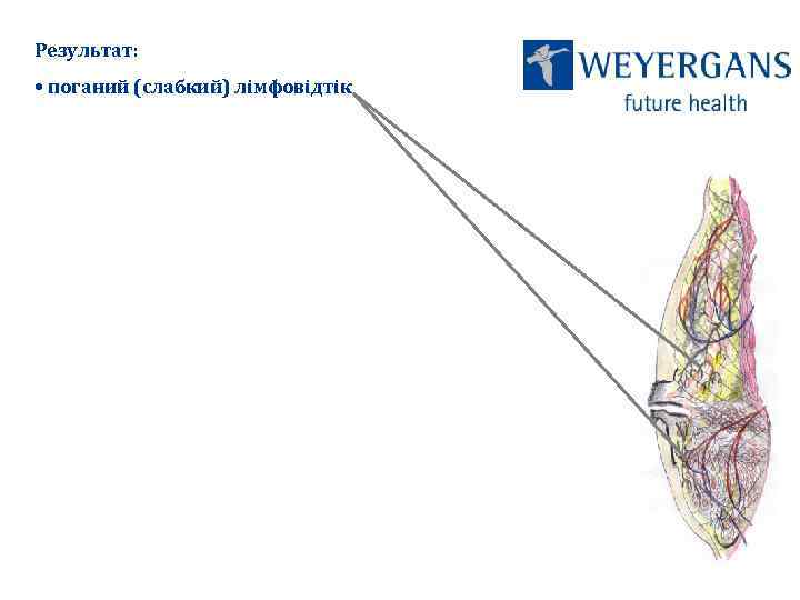 Результат: • поганий (слабкий) лімфовідтік 