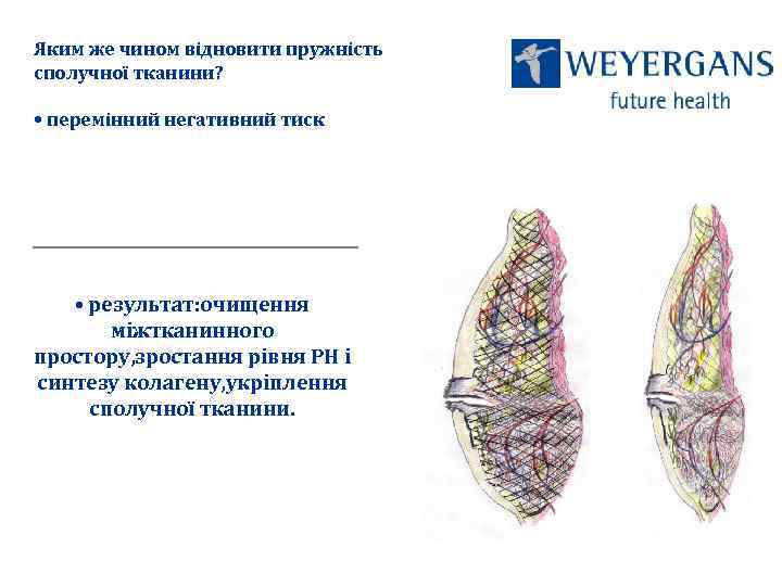 Яким же чином відновити пружність сполучної тканини? • перемінний негативний тиск • результат: очищення