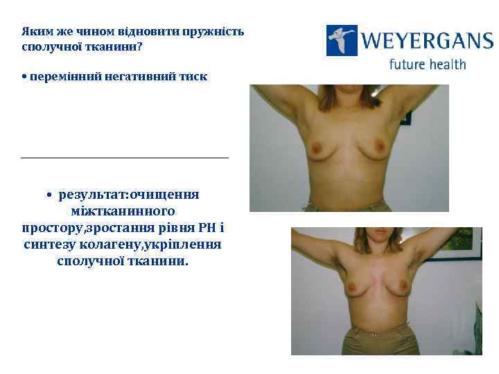 Яким же чином відновити пружність сполучної тканини? • перемінний негативний тиск • результат: очищення