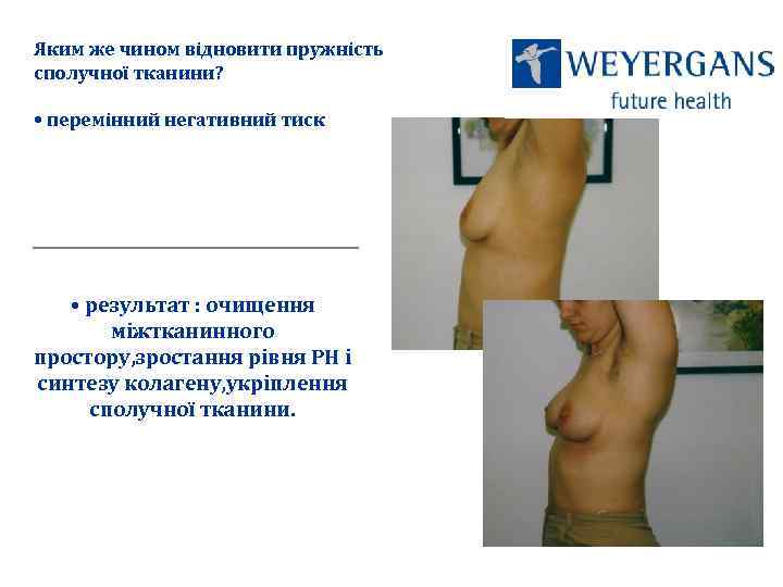 Яким же чином відновити пружність сполучної тканини? • перемінний негативний тиск • результат :