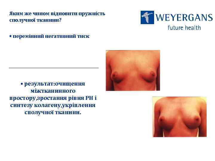 Яким же чином відновити пружність сполучної тканини? • перемінний негативний тиск • результат: очищення