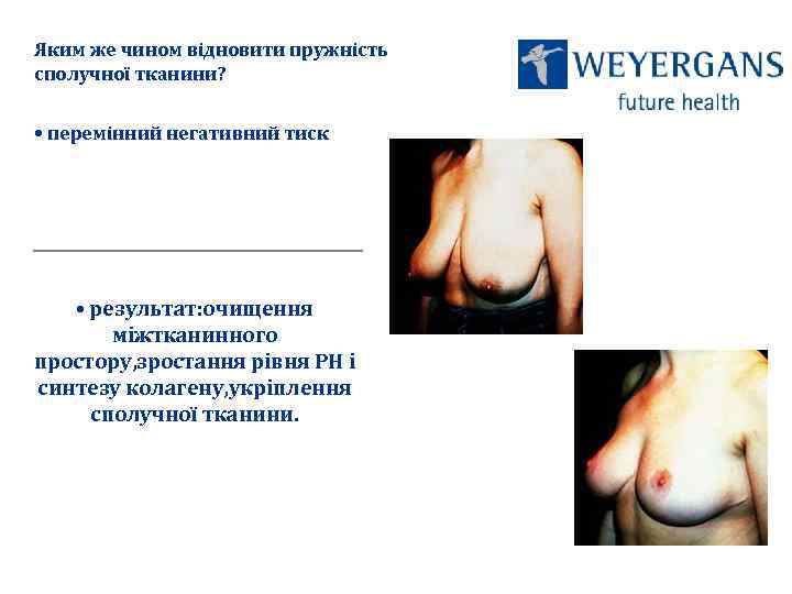 Яким же чином відновити пружність сполучної тканини? • перемінний негативний тиск • результат: очищення