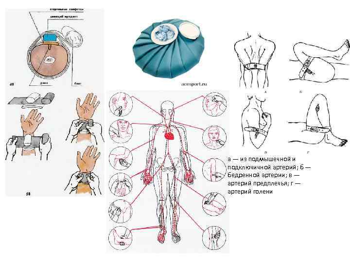 а — из подмышечной и подключичной артерий; б — бедренной артерии; в — артерий