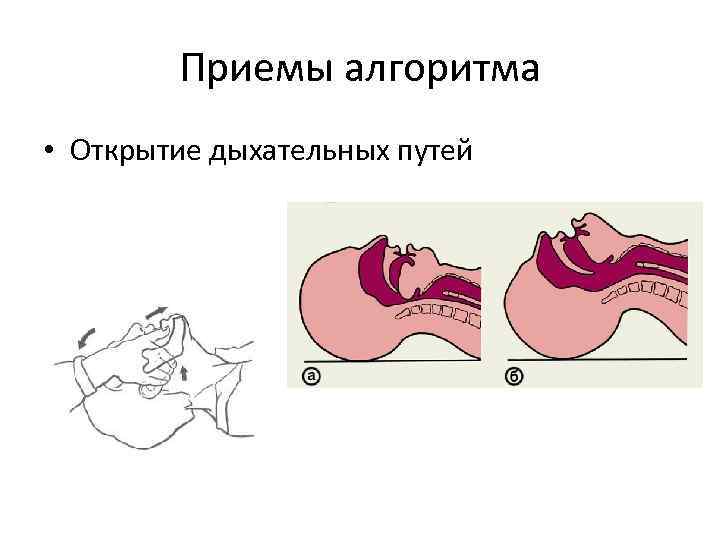 Приемы алгоритма • Открытие дыхательных путей 