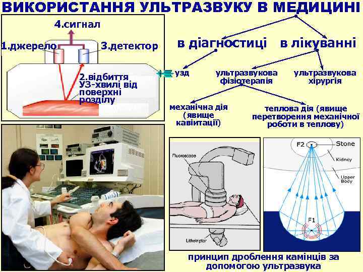ВИКОРИСТАННЯ УЛЬТРАЗВУКУ В МЕДИЦИНІ 4. сигнал 1. джерело УЗИ 3. детектор 2. відбиття УЗ-хвилі
