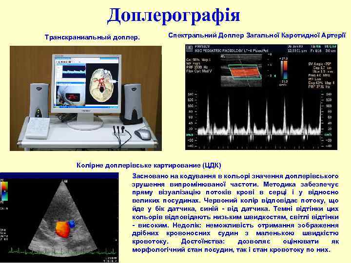 Доплерографія Транскраниальный доплер. Спектральний Доплер Загальної Каротидної Артерії Колірне доплерівське картирование (ЦДК) Засновано на