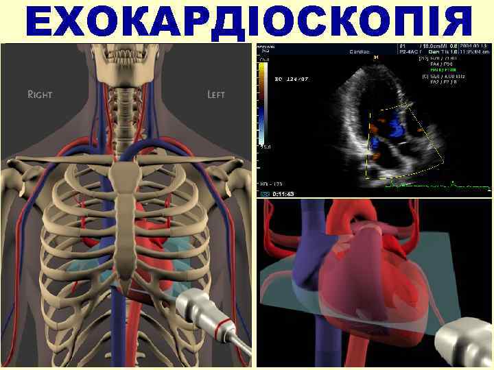 ЕХОКАРДІОСКОПІЯ 
