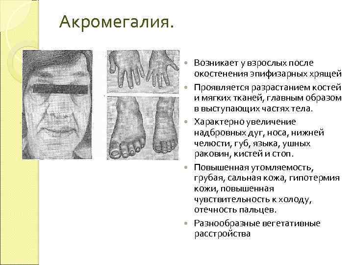 Акромегалия. Возникает у взрослых после окостенения эпифизарных хрящей Проявляется разрастанием костей и мягких тканей,