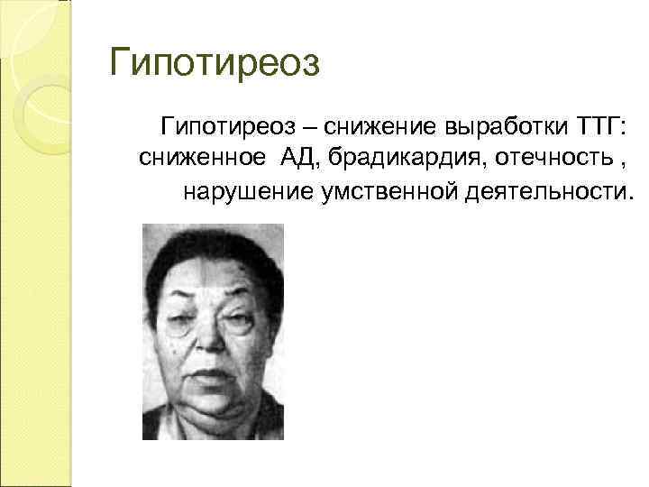 Гипотиреоз – снижение выработки ТТГ: сниженное АД, брадикардия, отечность , нарушение умственной деятельности. 