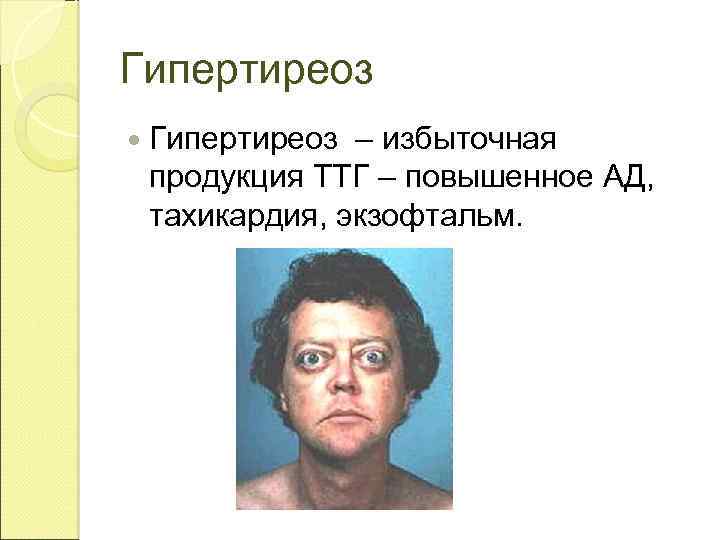 Гипертиреоз – избыточная продукция ТТГ – повышенное АД, тахикардия, экзофтальм. 