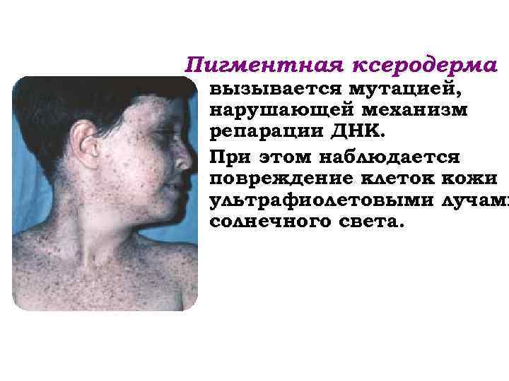 Пигментная ксеродерма вызывается мутацией, нарушающей механизм репарации ДНК. При этом наблюдается повреждение клеток кожи