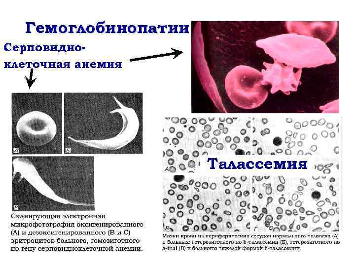 Серповидноклеточная анемия фото