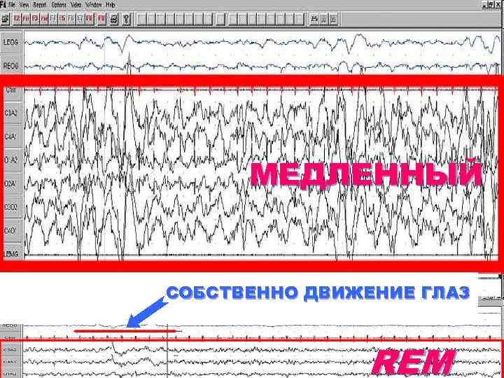 МЕДЛЕННЫЙ СОБСТВЕННО ДВИЖЕНИЕ ГЛАЗ REM 