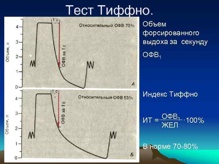 Тест Тиффно. Объем форсированного выдоха за секунду ОФВ 1 Индекс Тиффно ИТ = ОФВ