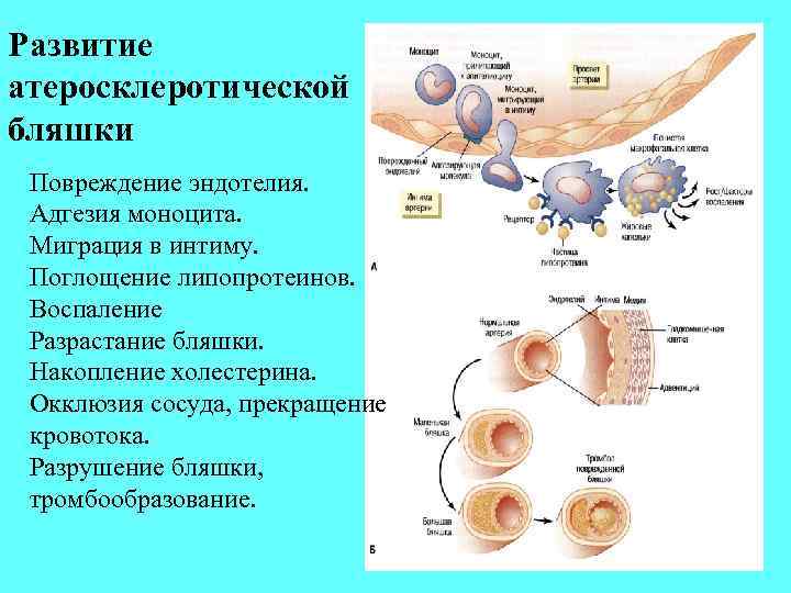 Развитие атеросклеротической бляшки Повреждение эндотелия. Адгезия моноцита. Миграция в интиму. Поглощение липопротеинов. Воспаление Разрастание