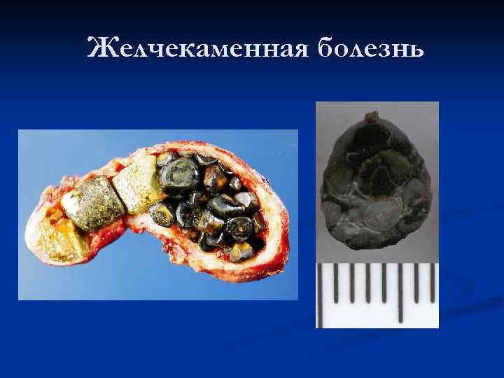 Желчекаменная болезнь 