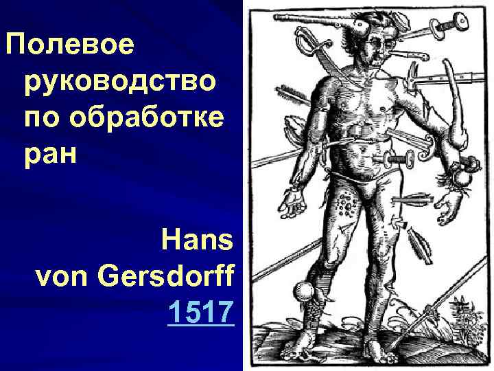 Полевое руководство по обработке ран Hans von Gersdorff 1517 
