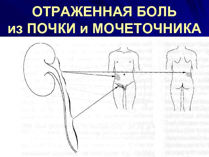 ОТРАЖЕННАЯ БОЛЬ из ПОЧКИ и МОЧЕТОЧНИКА 