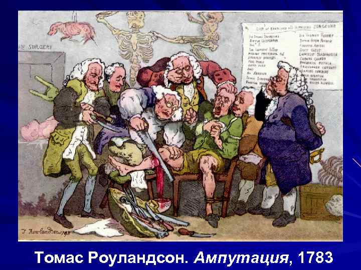 Томас Роуландсон. Ампутация, 1783 