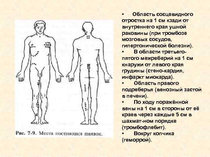  • Область сосцевидного отростка на 1 см кзади от внутреннего края ушной раковины