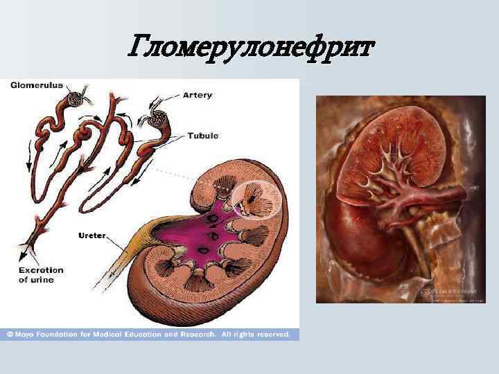 Гломерулонефрит 