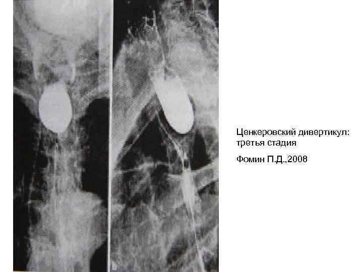 Ценкеровский дивертикул: третья стадия Фомин П. Д. , 2008 