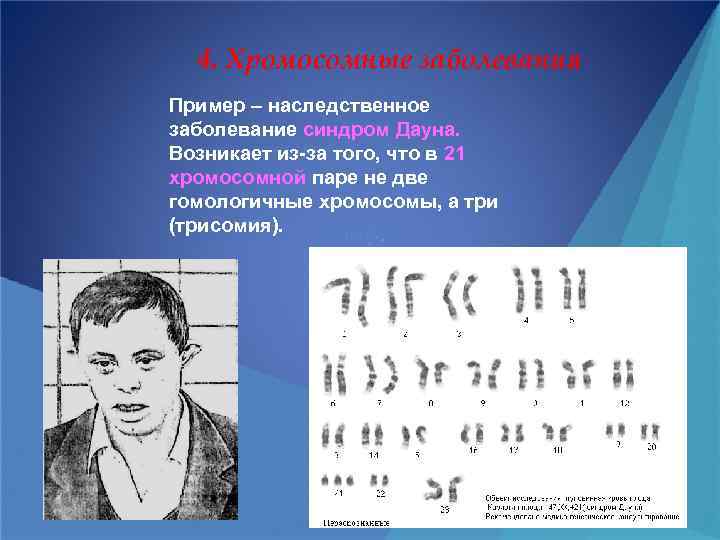 4. Хромосомные заболевания Пример – наследственное заболевание синдром Дауна. Возникает из-за того, что в