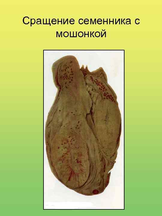 Сращение семенника с мошонкой 