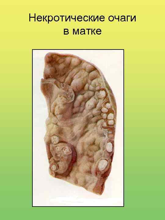 Некротические очаги в матке 