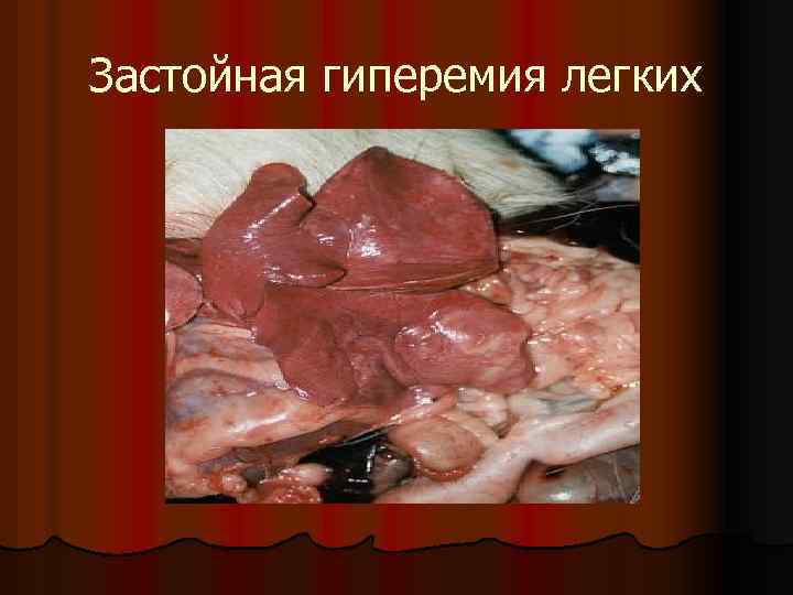 Застойная гиперемия легких 