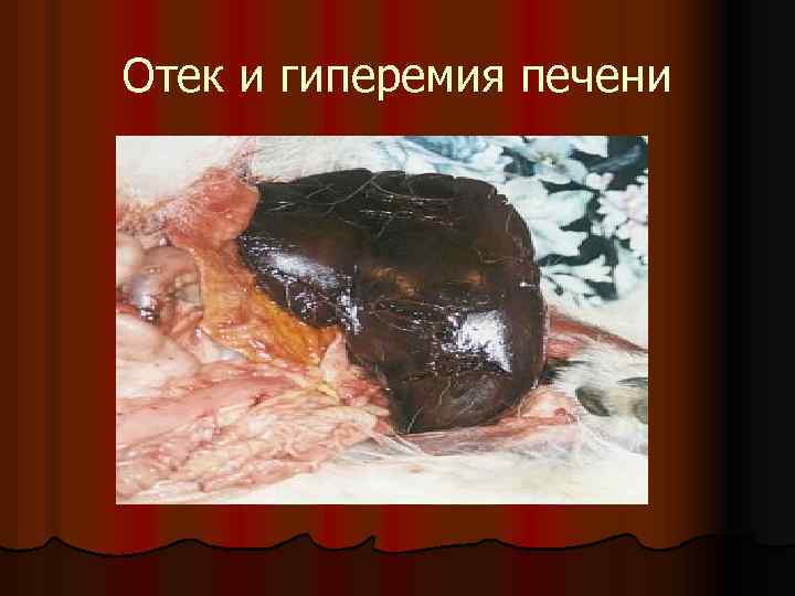 Отек и гиперемия печени 