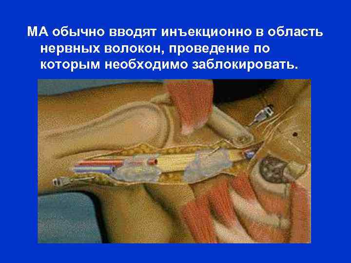 МА обычно вводят инъекционно в область нервных волокон, проведение по которым необходимо заблокировать. 