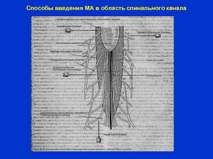 Способы введения МА в область спинального канала 