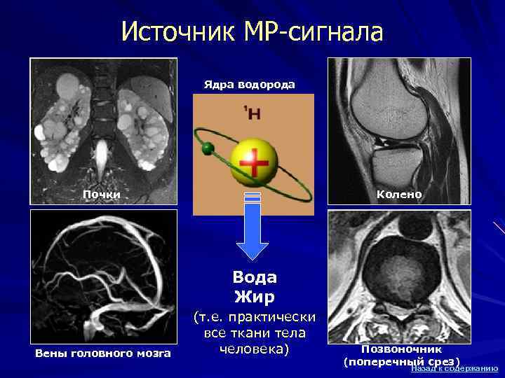 Источник МР-сигнала Ядра водорода Почки Колено Вода Жир Вены головного мозга (т. е. практически