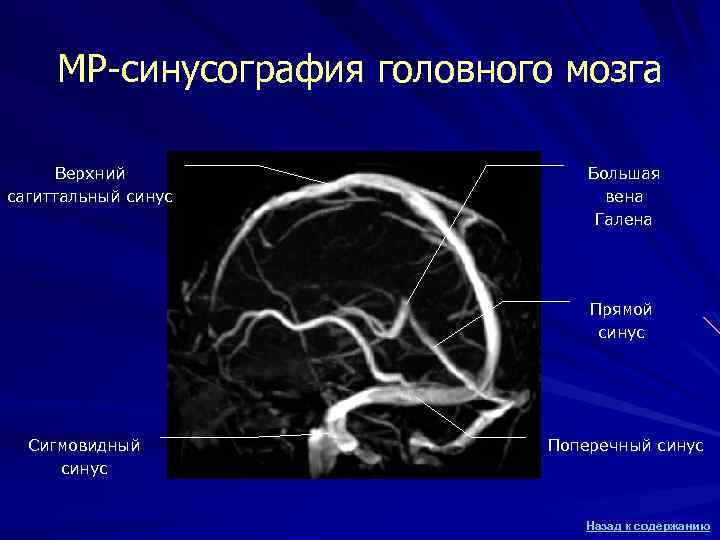 МР-синусография головного мозга Верхний сагиттальный синус Большая вена Галена Прямой синус Сигмовидный синус Поперечный