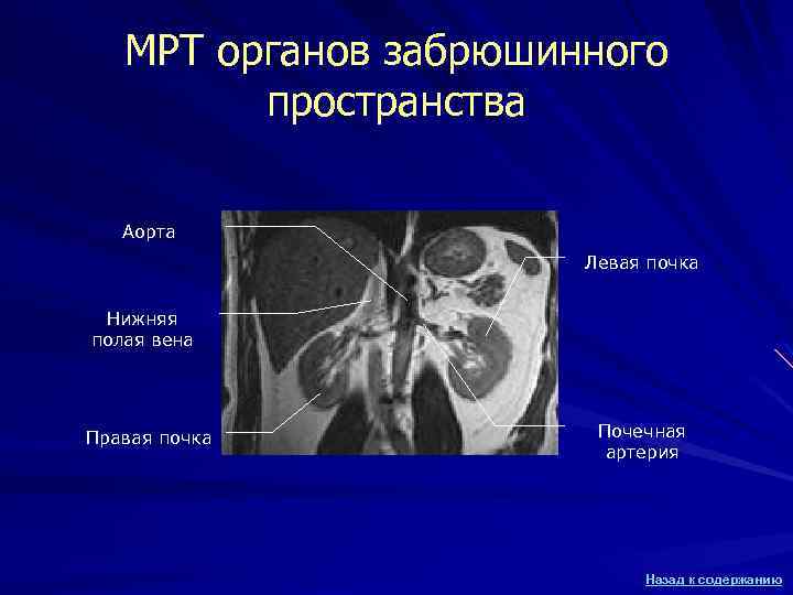 МРТ органов забрюшинного пространства Аорта Левая почка Нижняя полая вена Правая почка Почечная артерия