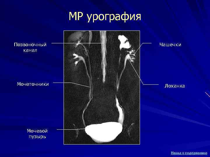 МР урография Позвоночный канал Мочеточники Чашечки Лоханка Мочевой пузырь Назад к содержанию 