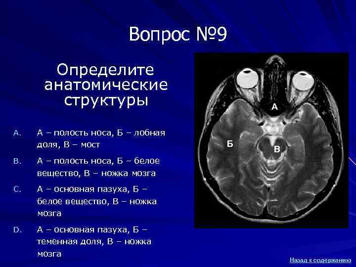 Вопрос № 9 Определите анатомические структуры A. А – полость носа, Б – лобная