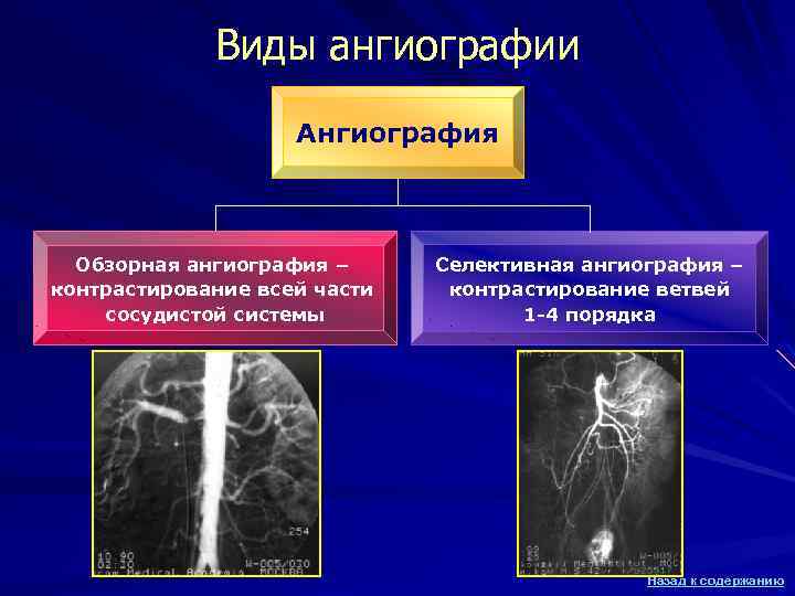 Виды ангиографии Ангиография Обзорная ангиография – контрастирование всей части сосудистой системы Селективная ангиография –