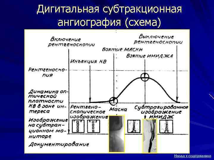 Дигитальная субтракционная ангиография (схема) Назад к содержанию 