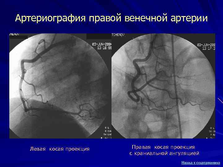 Артериография правой венечной артерии Левая косая проекция Правая косая проекция с краниальной ангуляцией Назад