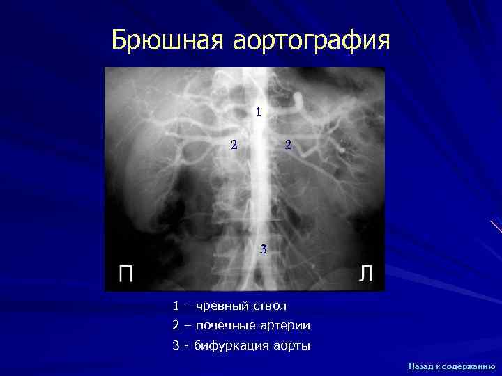 Брюшная аортография 1 2 2 3 1 – чревный ствол 2 – почечные артерии