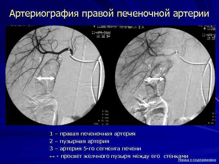 Артериография правой печеночной артерии 1 3 1 2 3 1 – правая печеночная артерия