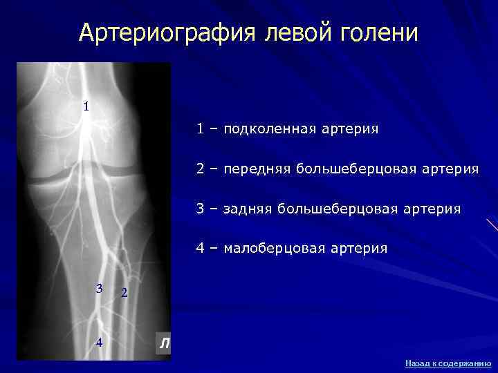 Артериография левой голени 1 1 – подколенная артерия 2 – передняя большеберцовая артерия 3