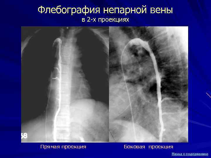 Флебография непарной вены в 2 -х проекциях Прямая проекция Боковая проекция Назад к содержанию