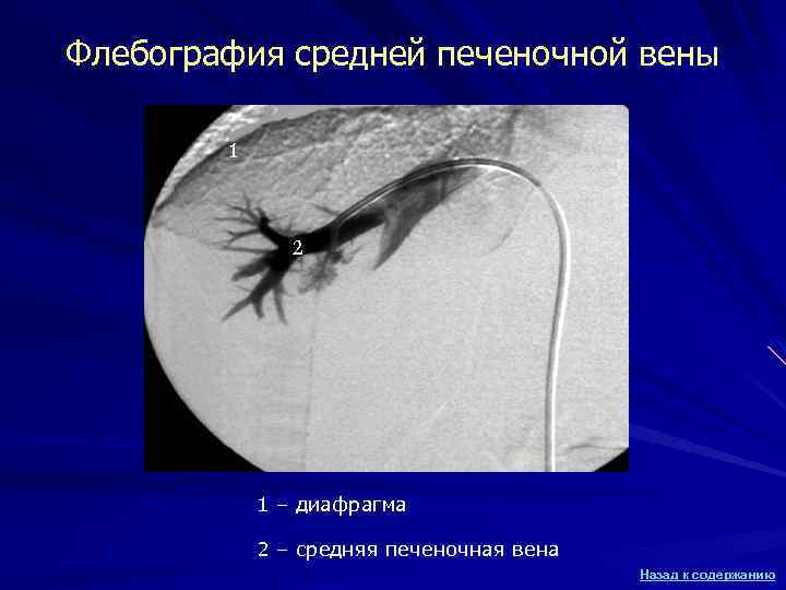 Флебография средней печеночной вены 1 2 1 – диафрагма 2 – средняя печеночная вена