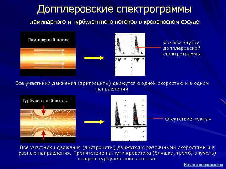 Допплеровские спектрограммы ламинарного и турбулентного потоков в кровеносном сосуде. «окно» внутри допплеровской спектрограммы Все